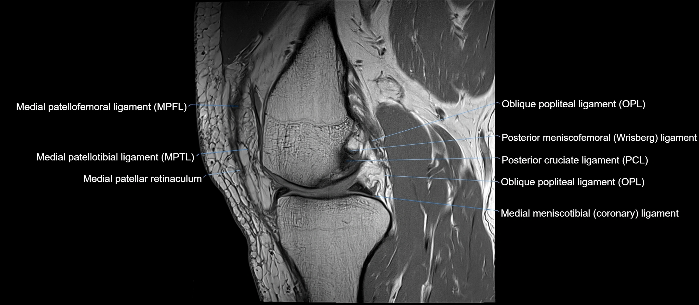 MRI sagittal  ligaments cross sectional anatomy 3T  radiology  image-img-00001-00020.webp
